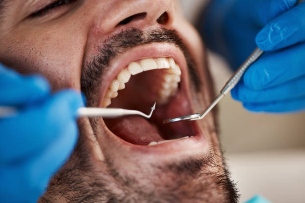 Best Emergency Dental Care for Broken or Chipped Teeth in Chester, SC